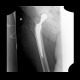 Hip replacement, cemented, leak of cement into the pelvis: X-ray - Plain radiograph